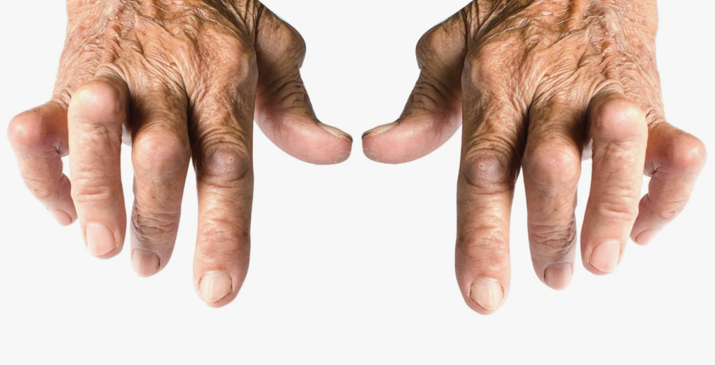 Ревматоидный артрит: его проявления и терапевтические стратегии